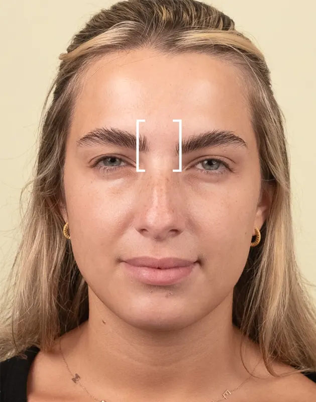 Between the eyebrows Between the eyebrows