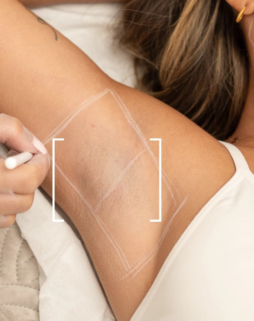 Excessive Sweating Underarms Excessive Sweating Underarms