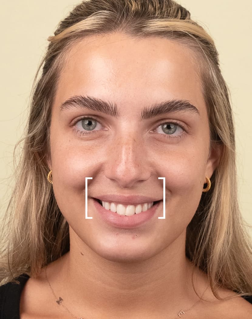 Gummy Smile Gummy Smile