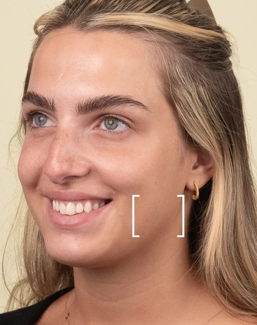 Masseter Muscle Masseter Muscle