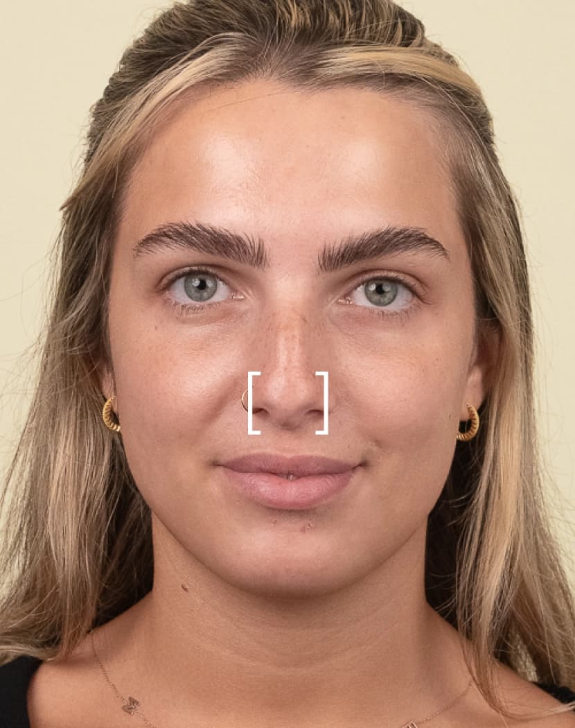 Nose Tip Lift Nose Tip Lift