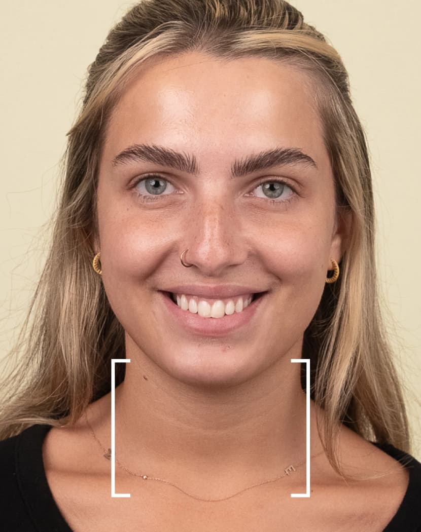 Platysma Bands Platysma Bands