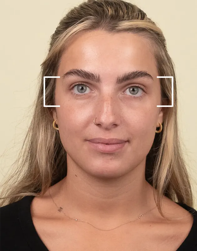 Crow's feet Crow's feet