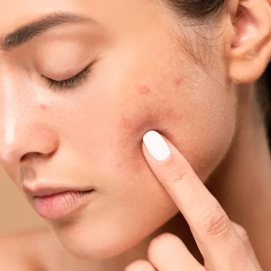 Acne Scarring Acne Scarring