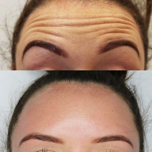 Before and after image of woman being treated with Botox