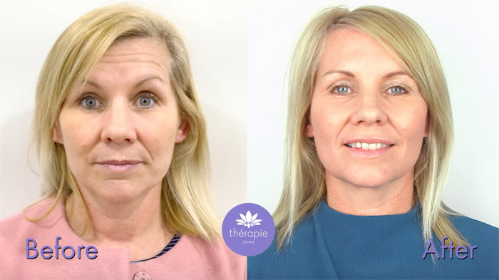 Look at some of the before and after photos of our client receiving Botulinum Toxin treatment at Thérapie Clinic