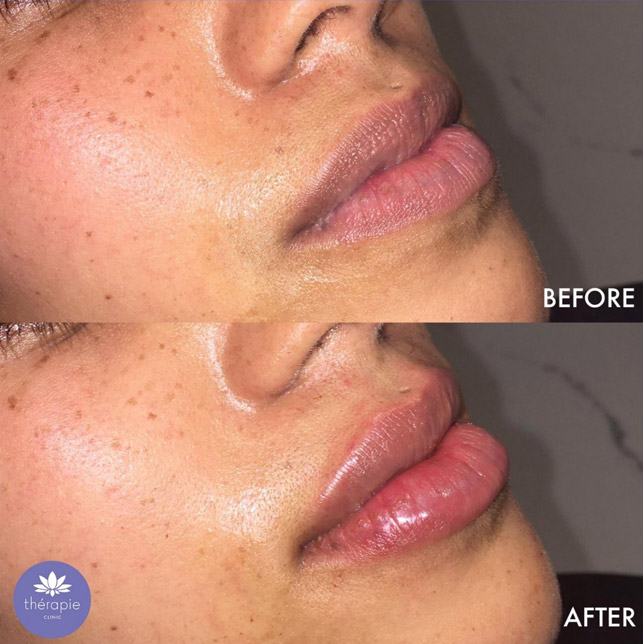 Female lips before and after lip filler treatment