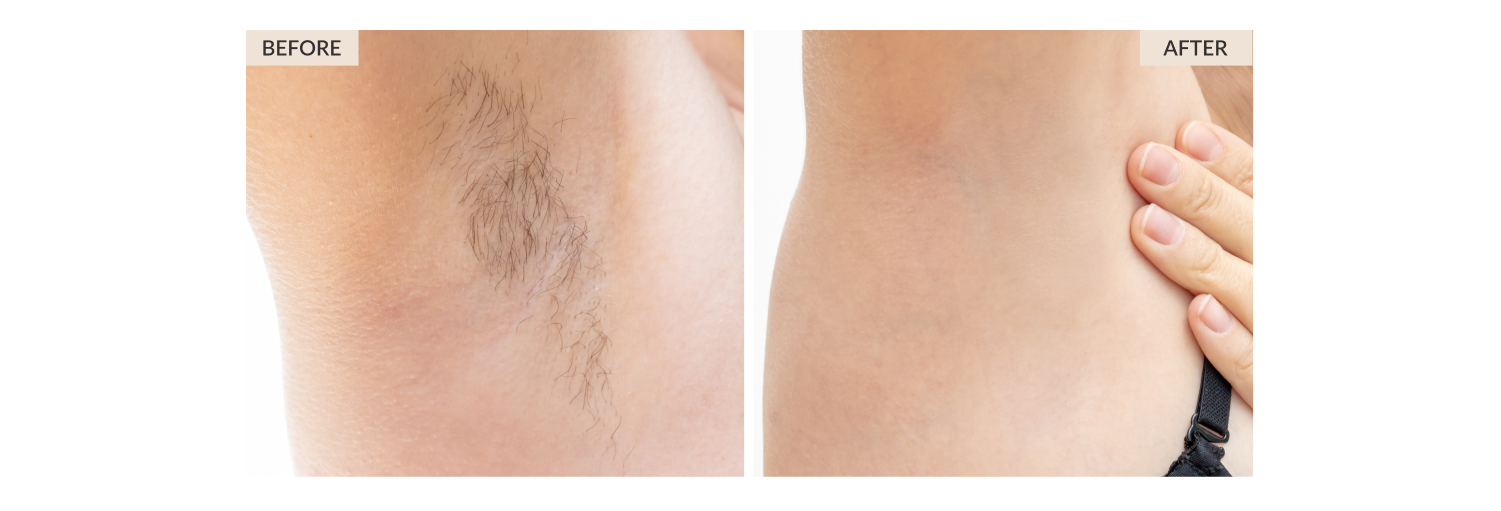 Laser Hair Removal for Women - Thérapie Clinic